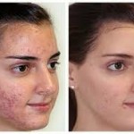 Causes of Acne – Part 2