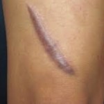 Keloid Scars and Hypertrophic Scars – Part 1