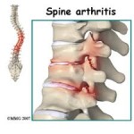 Spinal Arthritis – Part 1