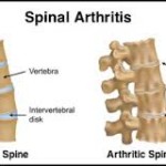 Spinal Arthritis – Part 2