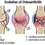 Glucosamine Chondroitin – Part 2