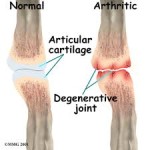 Degenerative Arthritis – Part 1