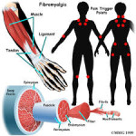 Fibromyalgia – Part 1