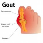 Gout Symptoms – Part 1