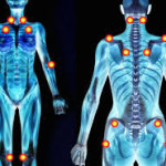 Fibromyalgia – Part 2