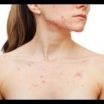 Body Acne – Part 1