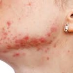 Causes of Cystic Acne – Part 1