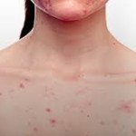 Body Acne – Part 2