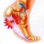 Plantar Fasciitis – Part 1