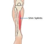 Shin Splints – Part 1