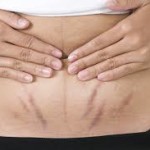Taking Care Of Stretch Marks After Childbirth – Part 3