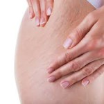 Natural Remedies For Stretch Marks – Part 2