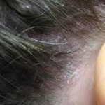 Scalp Acne – Part 2