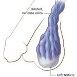 Varicose Veins in the Testicles