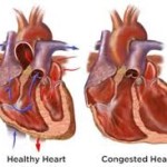 Life Expectancy for Congestive Heart Failure Disease – Part 2